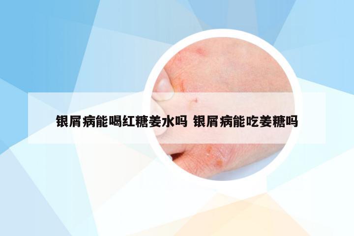 银屑病能喝红糖姜水吗 银屑病能吃姜糖吗