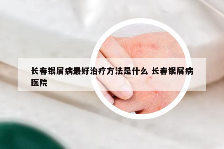 长春银屑病最好治疗方法是什么 长春银屑病医院