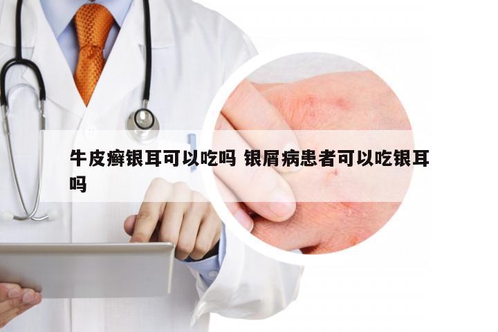 牛皮癣银耳可以吃吗 银屑病患者可以吃银耳吗