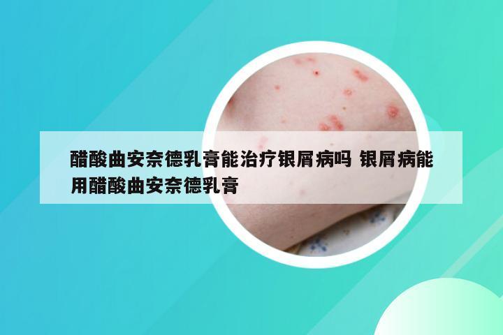 醋酸曲安奈德乳膏能治疗银屑病吗 银屑病能用醋酸曲安奈德乳膏