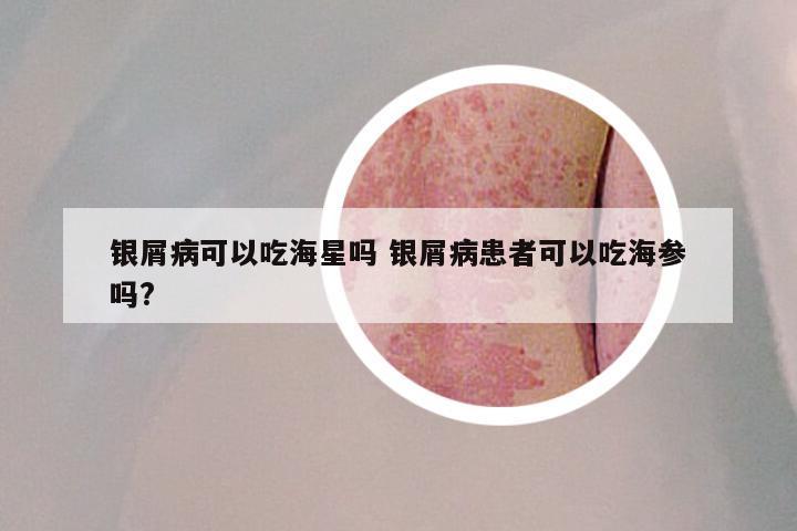 银屑病可以吃海星吗 银屑病患者可以吃海参吗?