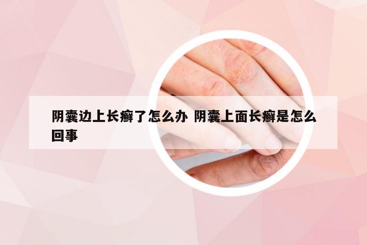 阴囊边上长癣了怎么办 阴囊上面长癣是怎么回事