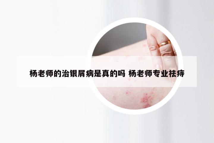 杨老师的治银屑病是真的吗 杨老师专业祛痔