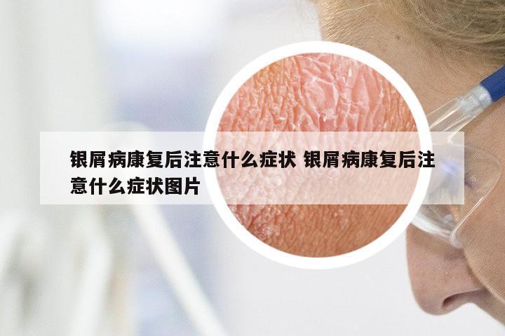 银屑病康复后注意什么症状 银屑病康复后注意什么症状图片