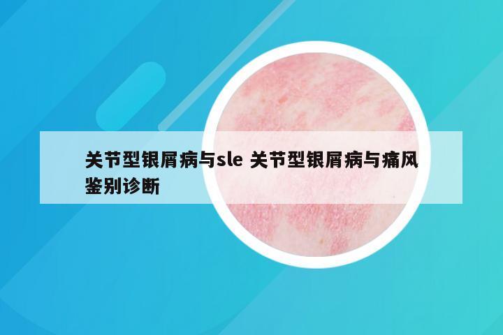 关节型银屑病与sle 关节型银屑病与痛风鉴别诊断