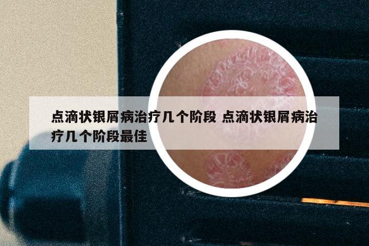 点滴状银屑病治疗几个阶段 点滴状银屑病治疗几个阶段最佳