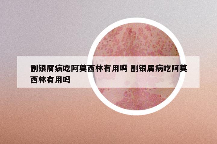 副银屑病吃阿莫西林有用吗 副银屑病吃阿莫西林有用吗