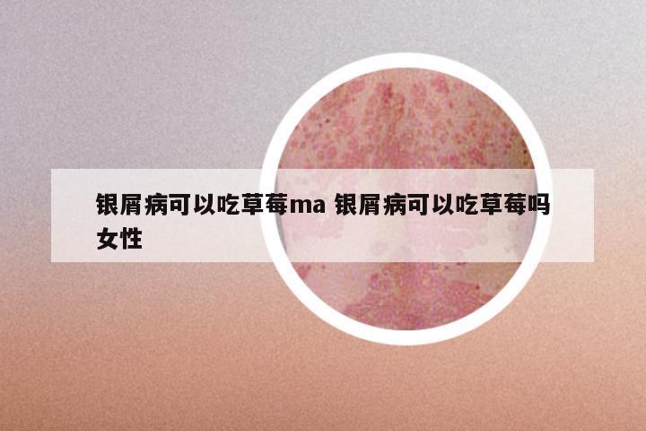 银屑病可以吃草莓ma 银屑病可以吃草莓吗女性