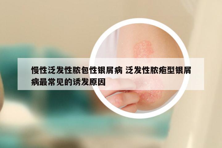 慢性泛发性脓包性银屑病 泛发性脓疱型银屑病最常见的诱发原因