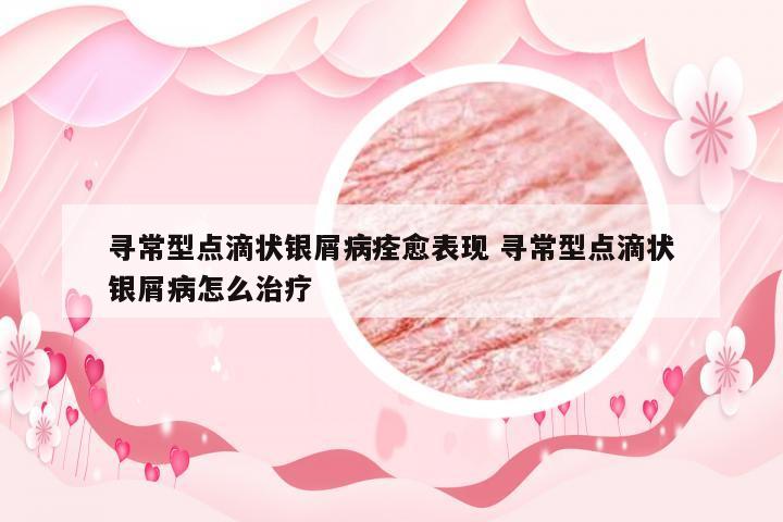 寻常型点滴状银屑病痊愈表现 寻常型点滴状银屑病怎么治疗