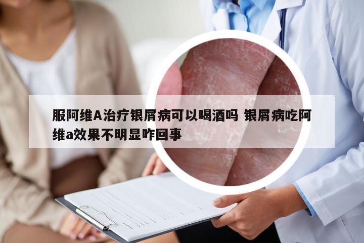 服阿维A治疗银屑病可以喝酒吗 银屑病吃阿维a效果不明显咋回事