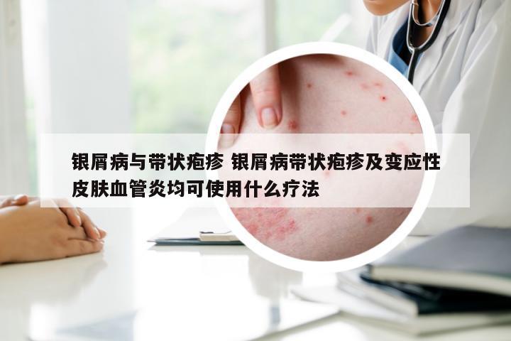 银屑病与带状疱疹 银屑病带状疱疹及变应性皮肤血管炎均可使用什么疗法