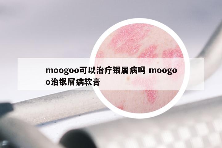 moogoo可以治疗银屑病吗 moogoo治银屑病软膏