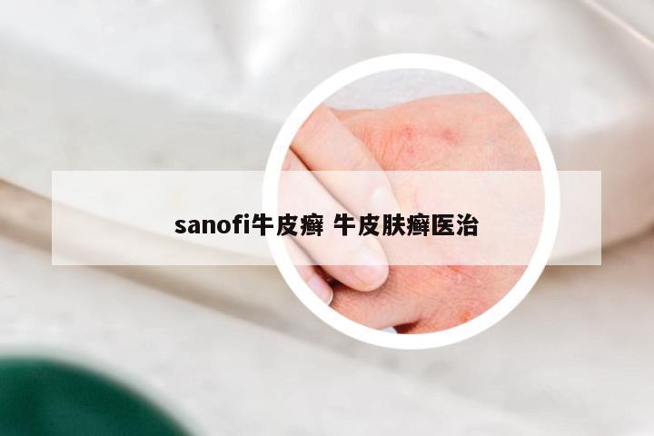 sanofi牛皮癣 牛皮肤癣医治