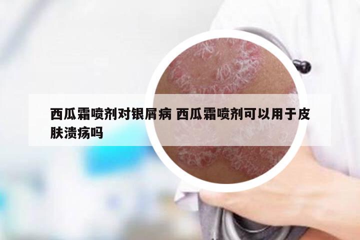 西瓜霜喷剂对银屑病 西瓜霜喷剂可以用于皮肤溃疡吗