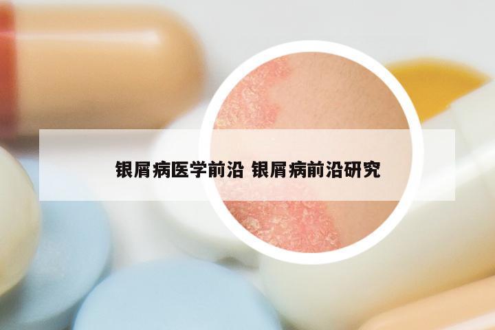 银屑病医学前沿 银屑病前沿研究