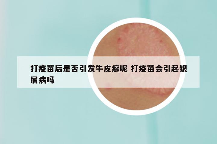 打疫苗后是否引发牛皮癣呢 打疫苗会引起银屑病吗