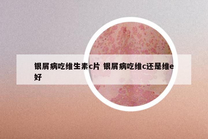 银屑病吃维生素c片 银屑病吃维c还是维e好