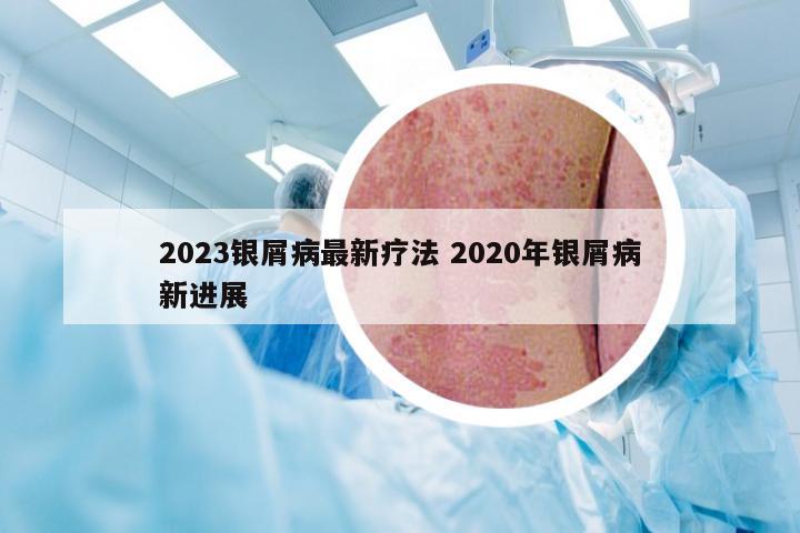 2023银屑病最新疗法 2020年银屑病新进展