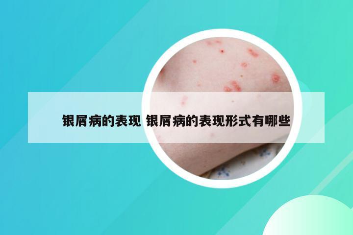 银屑病的表现 银屑病的表现形式有哪些