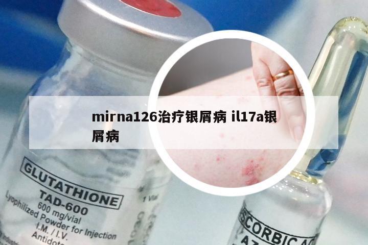 mirna126治疗银屑病 il17a银屑病