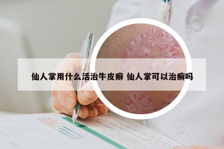 仙人掌用什么活治牛皮癣 仙人掌可以治癣吗