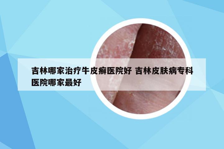 吉林哪家治疗牛皮癣医院好 吉林皮肤病专科医院哪家最好