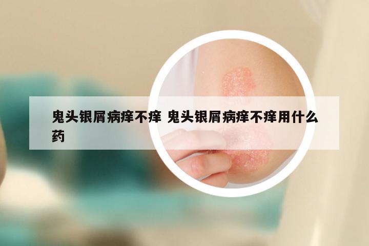 鬼头银屑病痒不痒 鬼头银屑病痒不痒用什么药