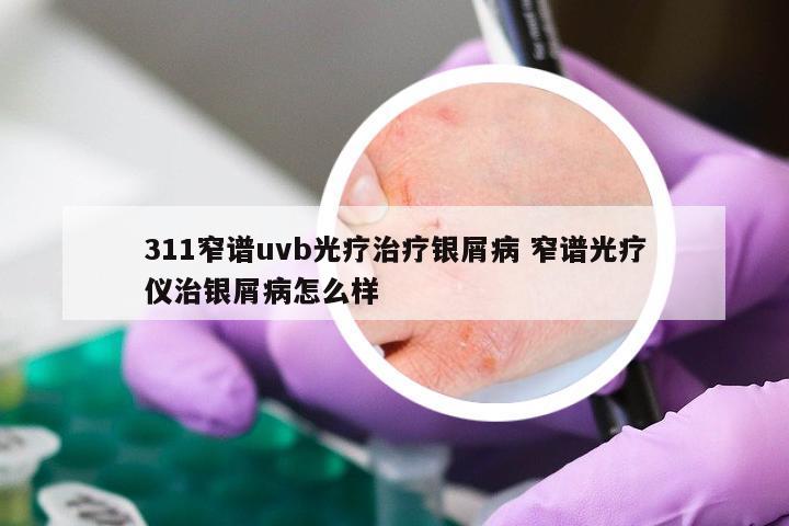 311窄谱uvb光疗治疗银屑病 窄谱光疗仪治银屑病怎么样