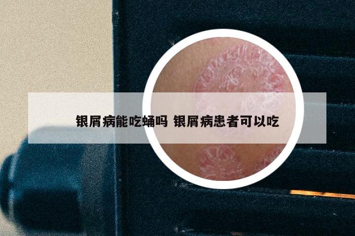 银屑病能吃蛹吗 银屑病患者可以吃