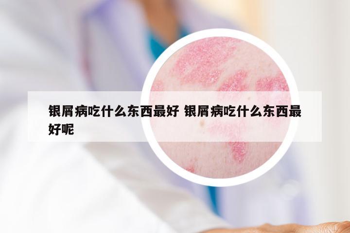 银屑病吃什么东西最好 银屑病吃什么东西最好呢