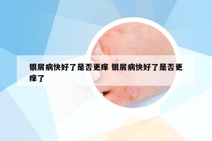 银屑病快好了是否更痒 银屑病快好了是否更痒了