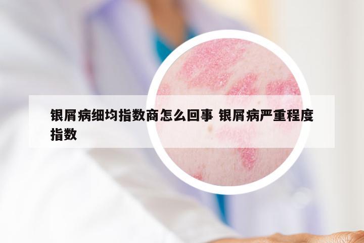 银屑病细均指数商怎么回事 银屑病严重程度指数