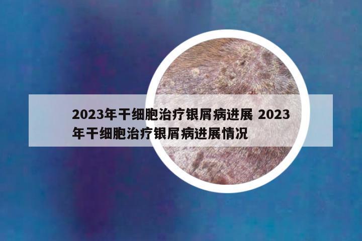 2023年干细胞治疗银屑病进展 2023年干细胞治疗银屑病进展情况