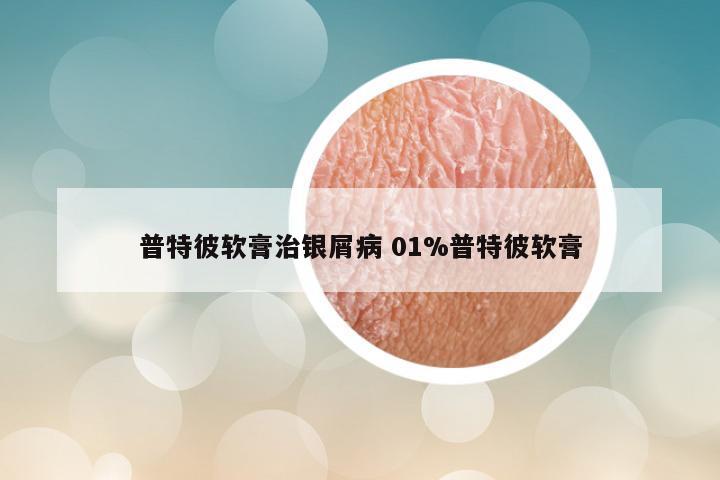 普特彼软膏治银屑病 01%普特彼软膏