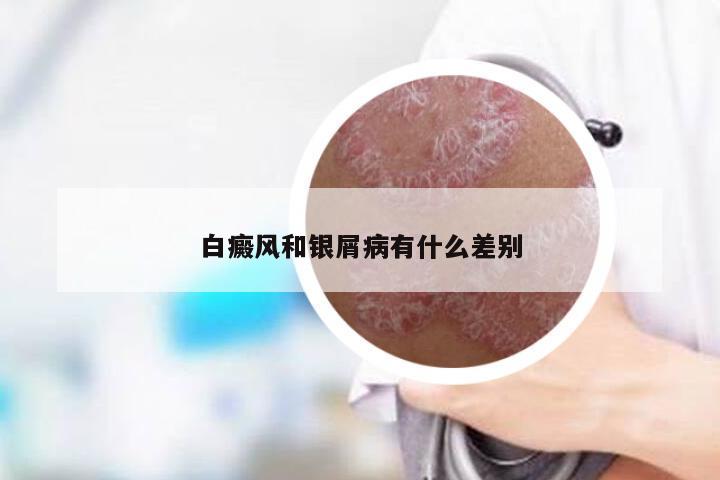 白癜风和银屑病有什么差别