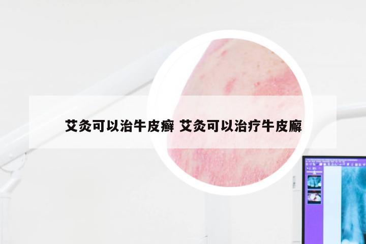 艾灸可以治牛皮癣 艾灸可以治疗牛皮廨