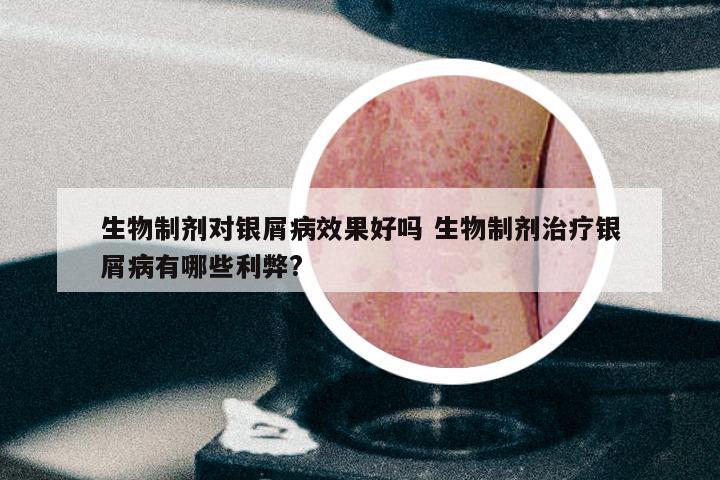 生物制剂对银屑病效果好吗 生物制剂治疗银屑病有哪些利弊?