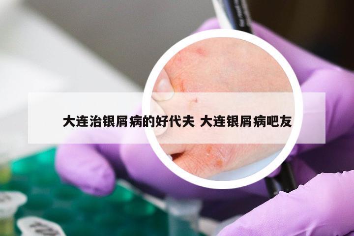 大连治银屑病的好代夫 大连银屑病吧友