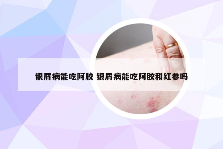 银屑病能吃阿胶 银屑病能吃阿胶和红参吗