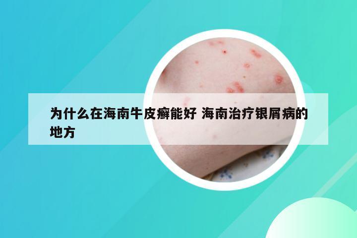 为什么在海南牛皮癣能好 海南治疗银屑病的地方