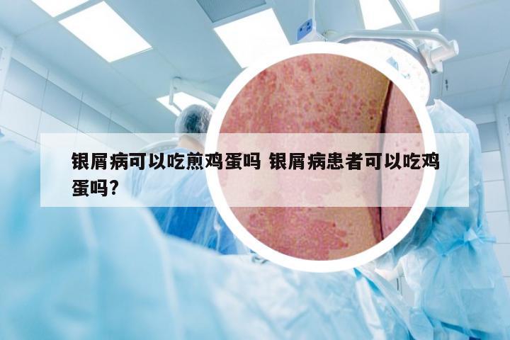 银屑病可以吃煎鸡蛋吗 银屑病患者可以吃鸡蛋吗?