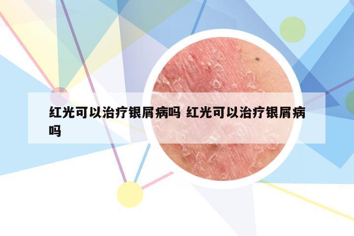 红光可以治疗银屑病吗 红光可以治疗银屑病吗