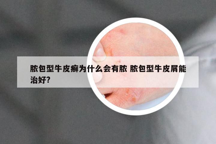 脓包型牛皮癣为什么会有脓 脓包型牛皮屑能治好?