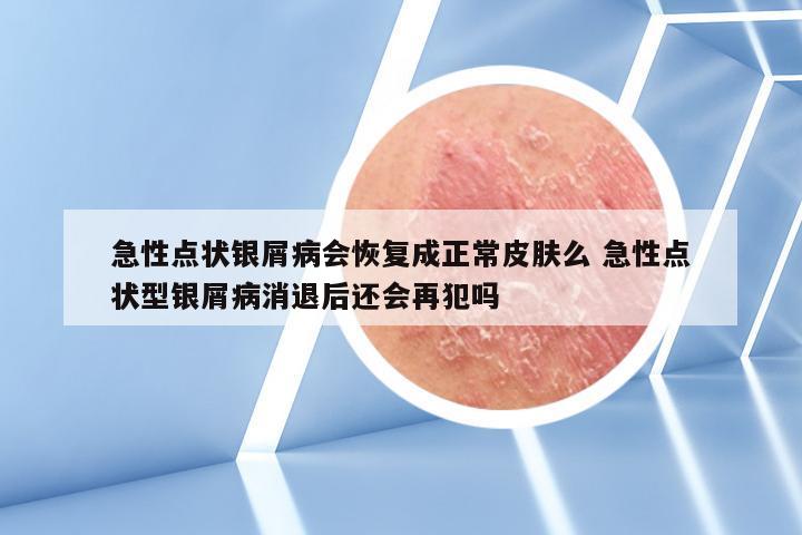 急性点状银屑病会恢复成正常皮肤么 急性点状型银屑病消退后还会再犯吗