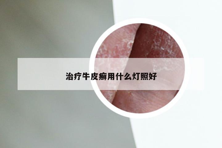 治疗牛皮癣用什么灯照好