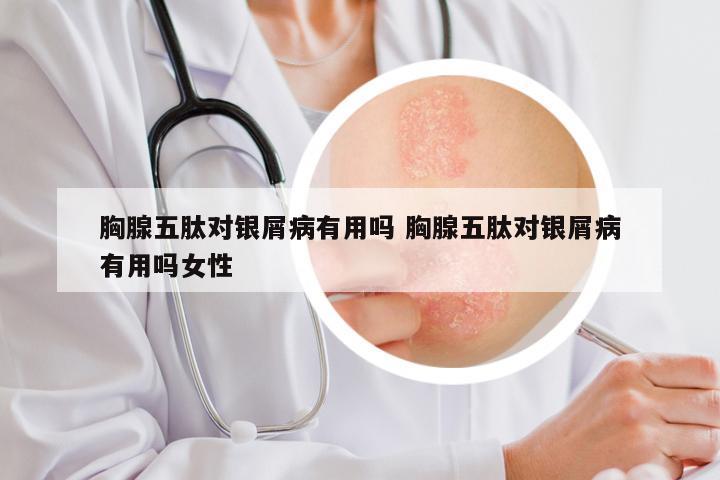 胸腺五肽对银屑病有用吗 胸腺五肽对银屑病有用吗女性