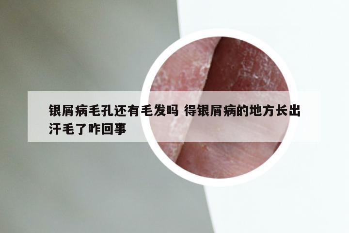 银屑病毛孔还有毛发吗 得银屑病的地方长出汗毛了咋回事