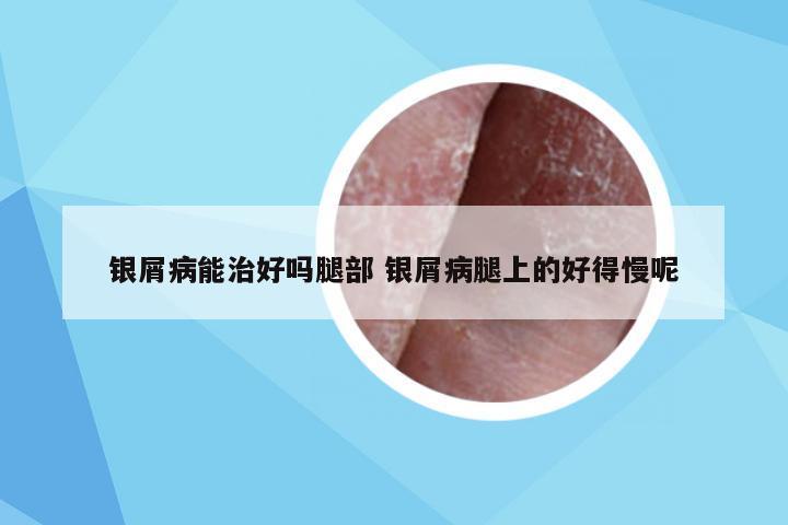 银屑病能治好吗腿部 银屑病腿上的好得慢呢