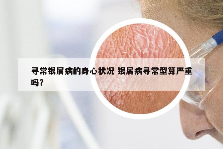 寻常银屑病的身心状况 银屑病寻常型算严重吗?